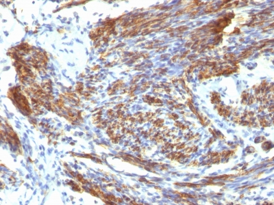 Formalin-fixed, paraffin embedded human uterus sections stained with 100 ul anti-Caldesmon, HMW (clone CALD1/820) at 1:50. HIER epitope retrieval prior to staining was performed in 10mM Tris 1mM EDTA, pH 9.0.